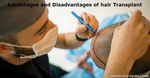The Advantages and Disadvantages of Hair Transplant