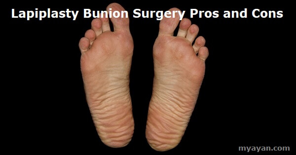 Lapiplasty Bunion Surgery Pros and Cons