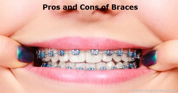 Pros and Cons of Braces