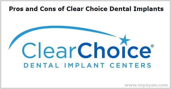 Pros and Cons of Clear Choice Dental Implants