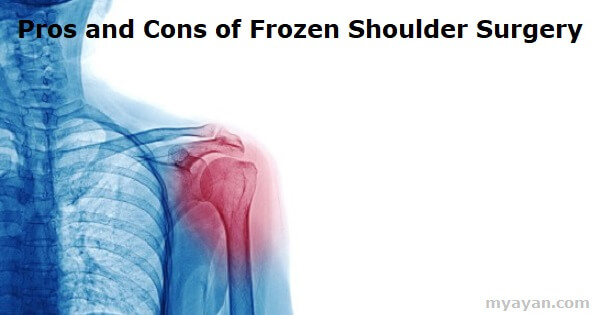 Pros and Cons of Frozen Shoulder Surgery