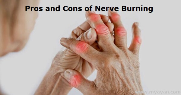 Pros and Cons of Nerve Burning