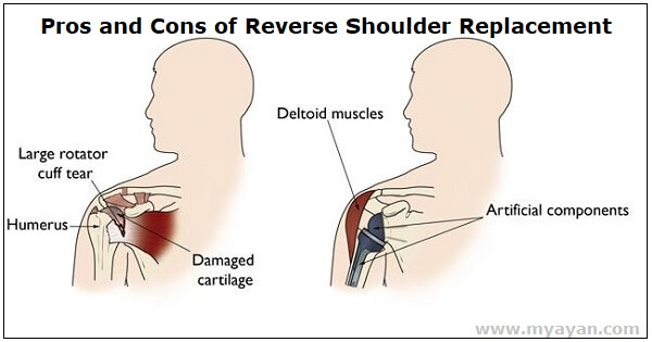Pros and Cons of Reverse Shoulder Replacement