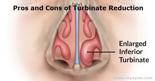 Pros and Cons of Turbinate Reduction - Septoplasty